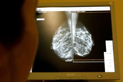 Reuters/Eric Gaillard/arkiv. En læge undersøger røntgenfotos efter en mammografi som led i en rutinemæssig undersøgelse.