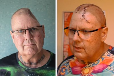 Det skulle være første gang, at et dansk sygehus printer et halvt hoved.