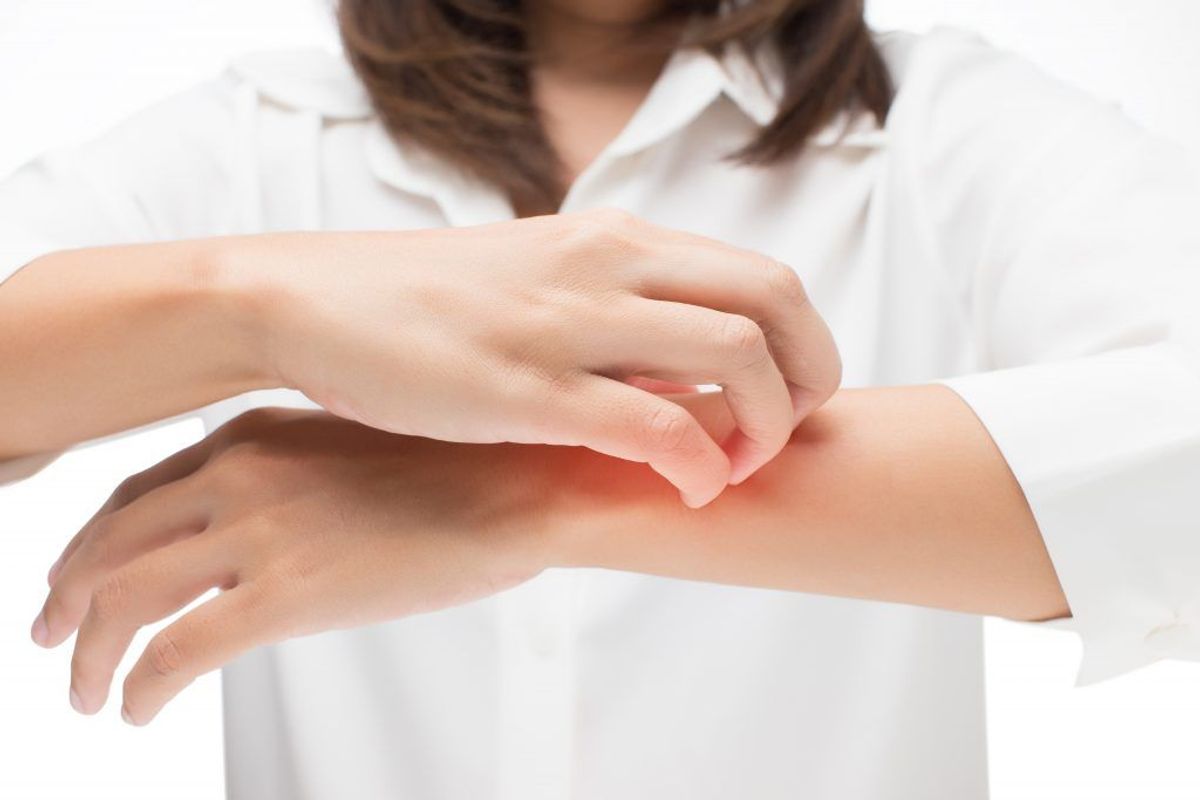Eksem. Kilde: Sundhedsguiden.dk. Arkivfoto.