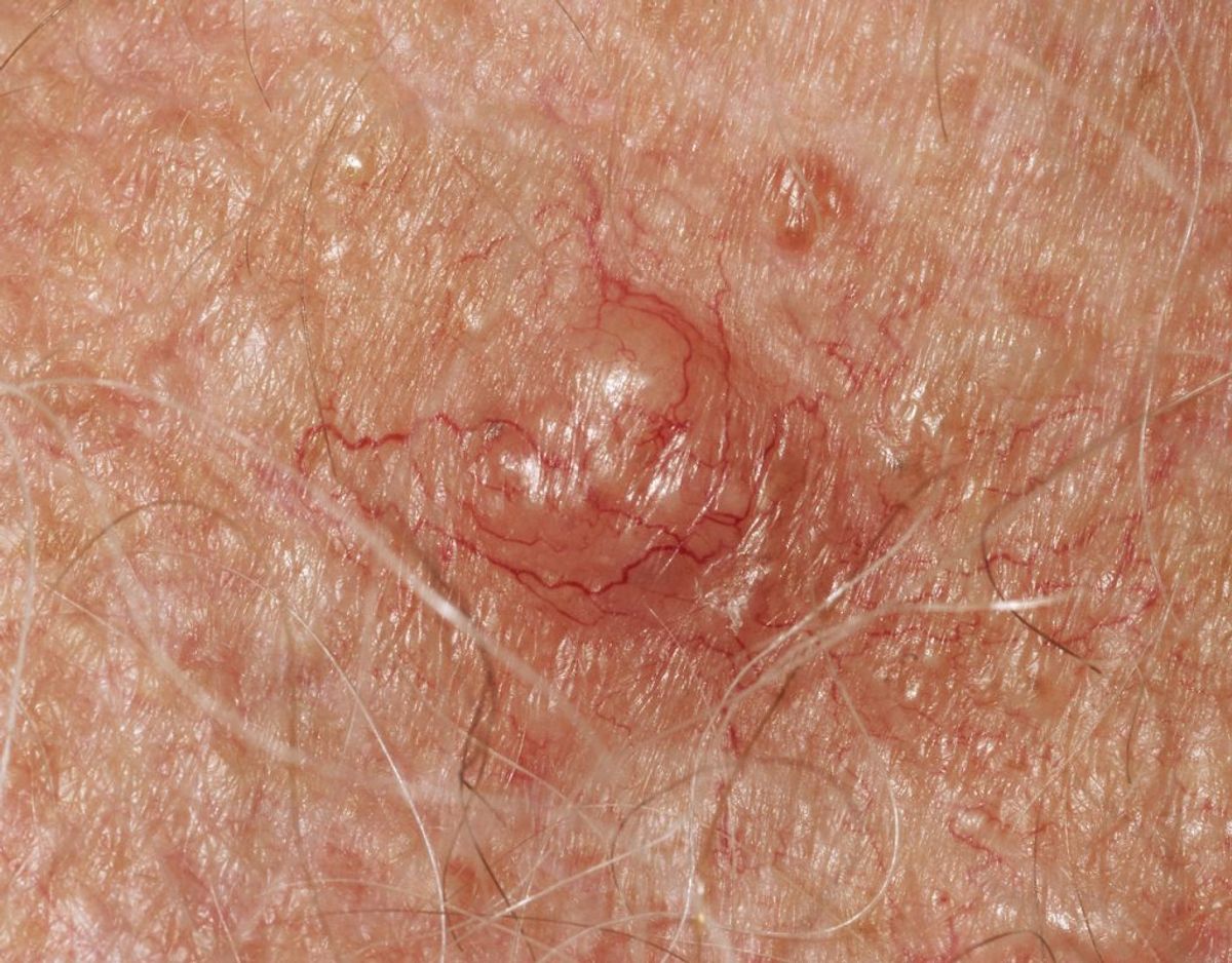 Fotos af hudkræft: Sådan kan det se ud, når man er ramt af basalcellekræft- carcinoma basocellulare- der er den almindeligste form for hudkræft. Foto: Scanpix.
