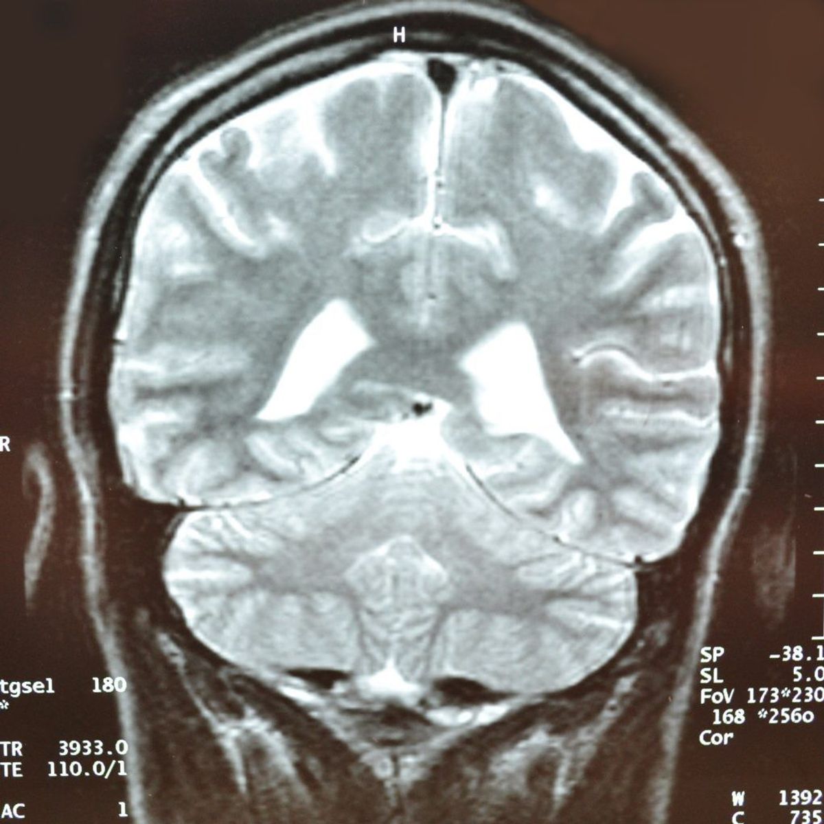 Efter hovedpine er epilepsi den hyppigste neurologiske lidelse.
