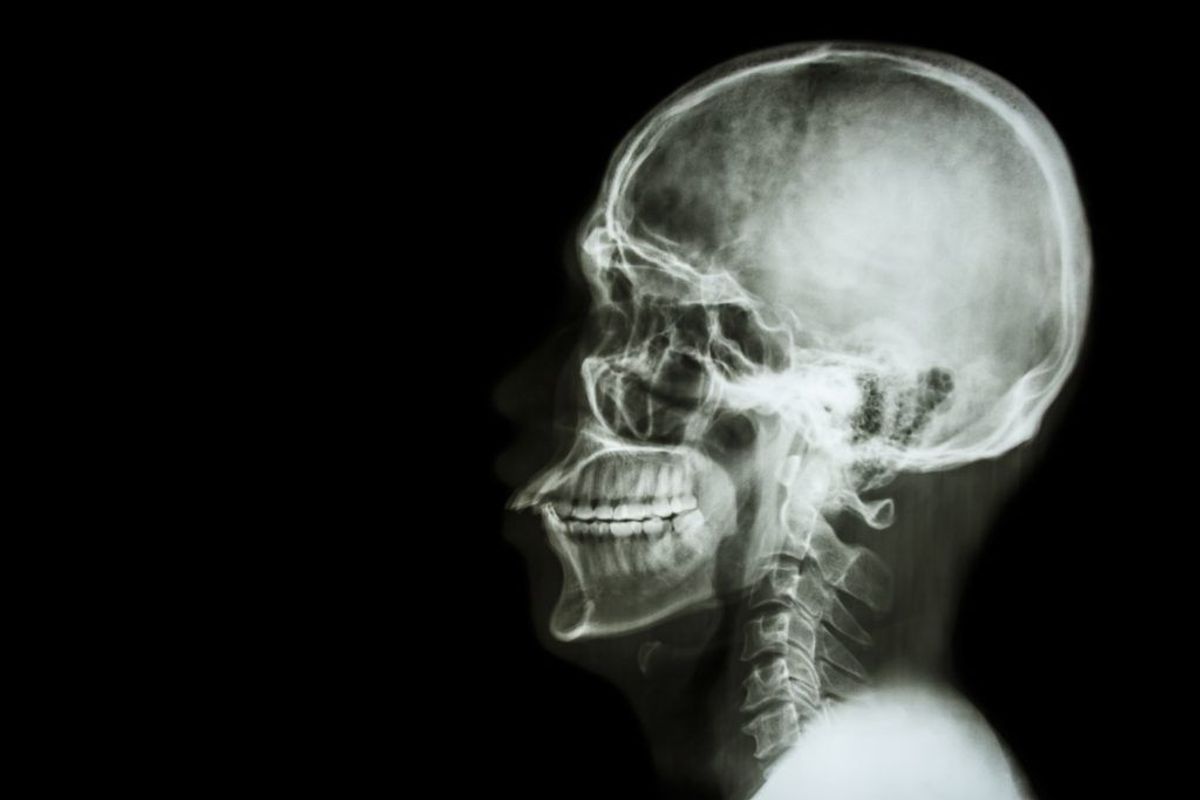 En MR- eller CT-scanning afslører oftest hjernetumorer. (Foto: Shutterstock)