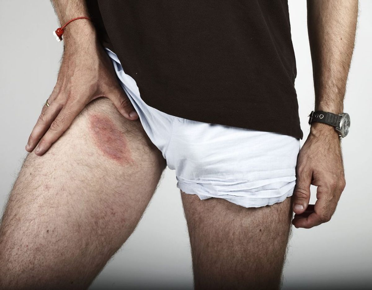 Borrelia-infektion efter bid fra en skovflåt viser sig som et rødt udslet rundt om bidstedet. Foto: Scanpix