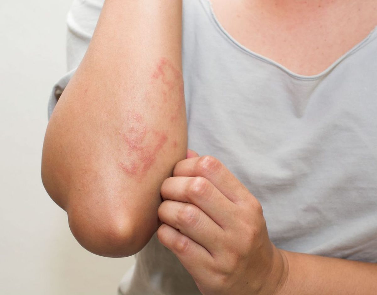 Kontaktallergi kommer til udtryk som allergisk nældefeber, eksem og udslæt, særligt hvis du kommer direkte i kontakt med bestemte fødevarer, tøj og meget andet. Foto/Kilde: Scanpix/Politiet.
