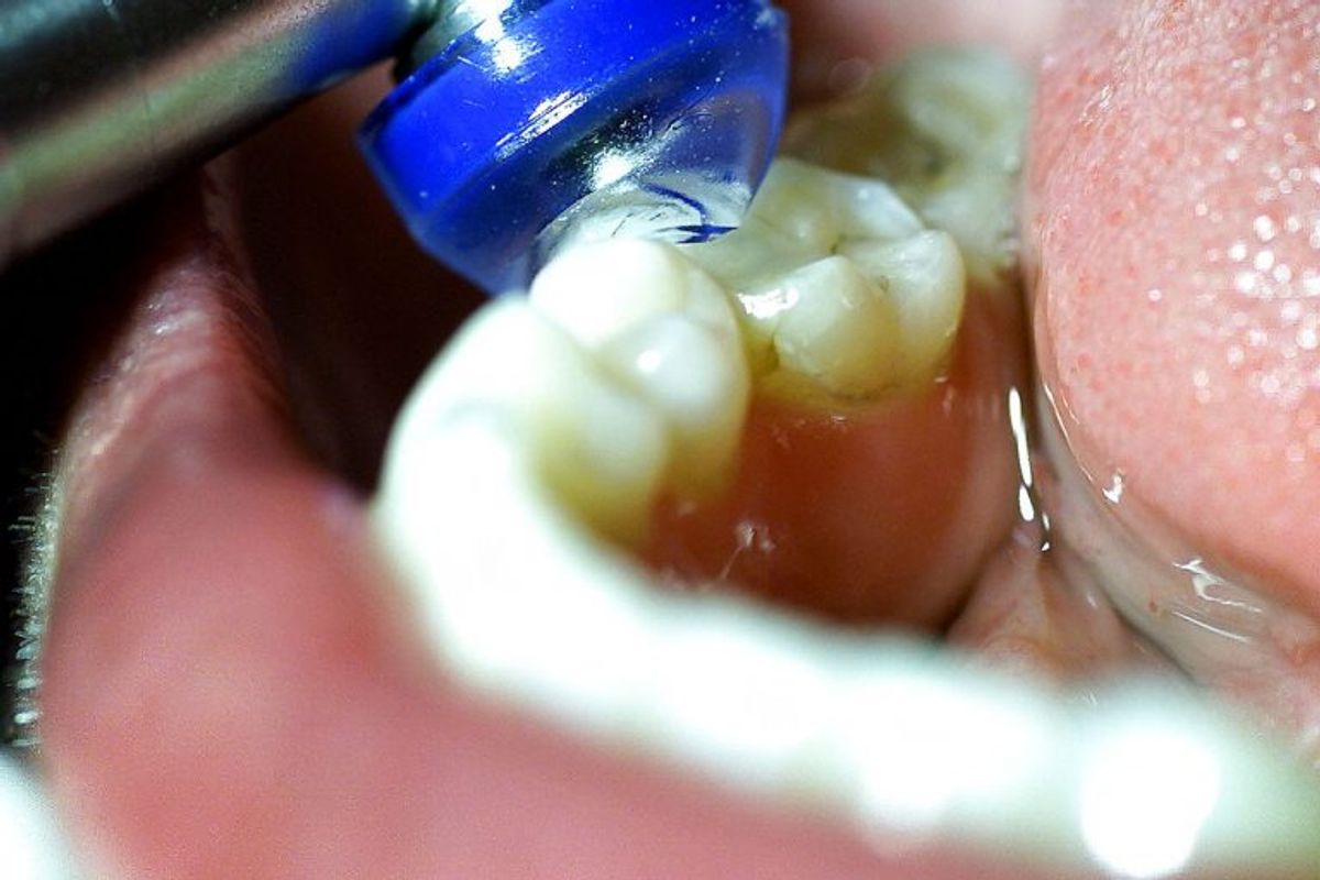 Tandlæge Ninni Holstein, Jægersborgs Alle 80, er en af de første i Danmark som bruger “Ozon Terapi” til tandbehandling. Behandlingen går ud på at “gasse” bakterier i munden. På billedet ses det specielle mundstykke som bruges til at gasse tænderne med.