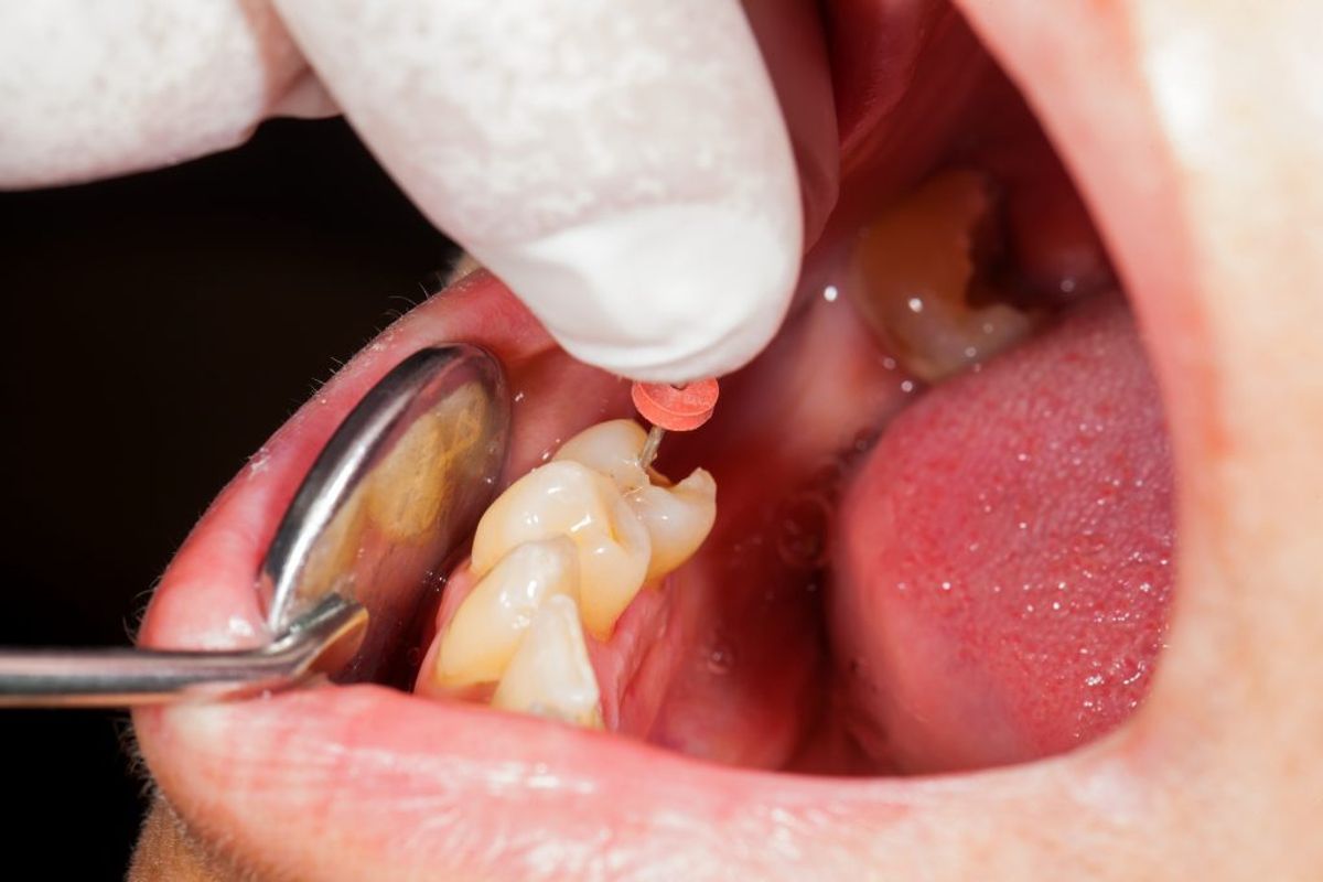 Rodbetændelse kan også give generelt dårlig smag i munden. Foto: Scanpix