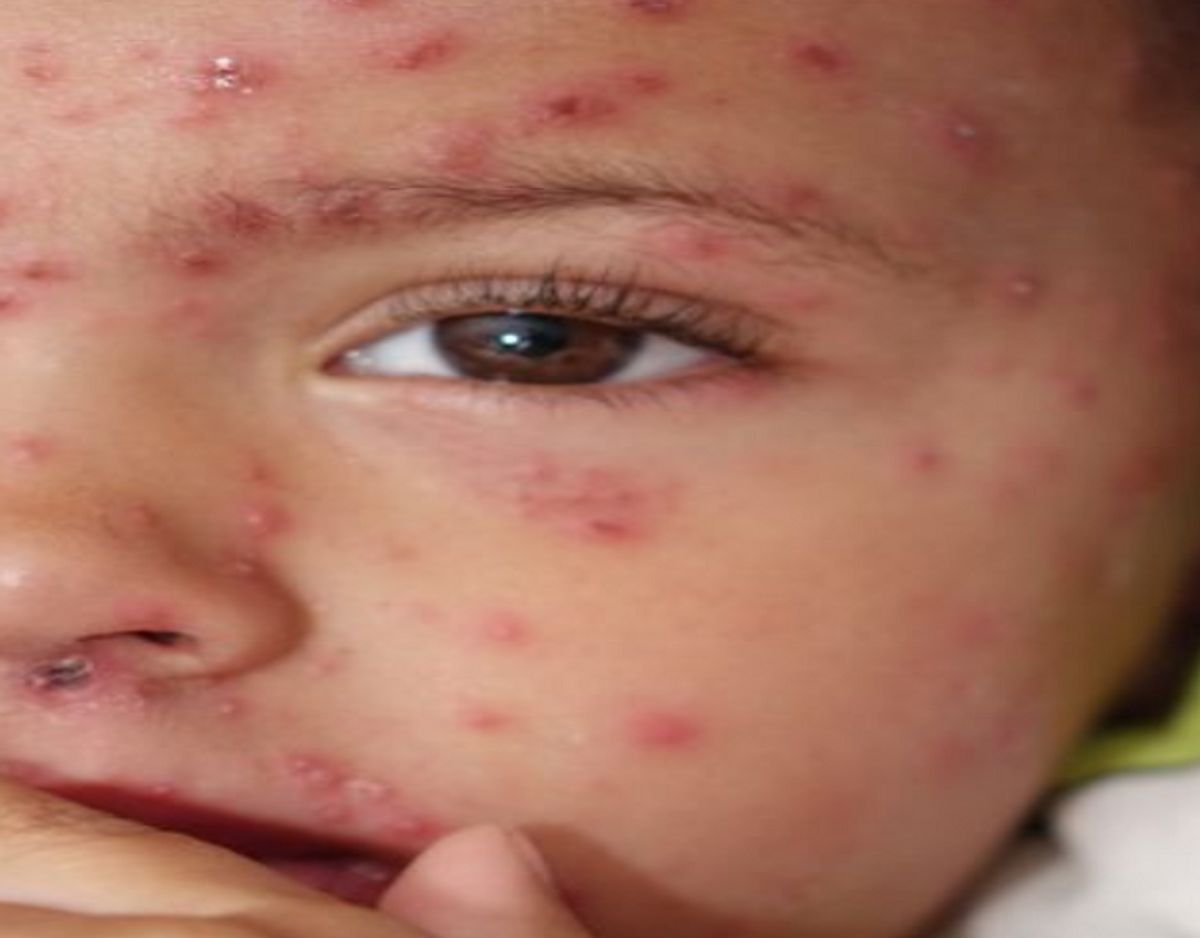 Mæslinger er en del af MFR-vaccinen. Alligevel er den ikke helt udryddet. Foto: Colourbox.