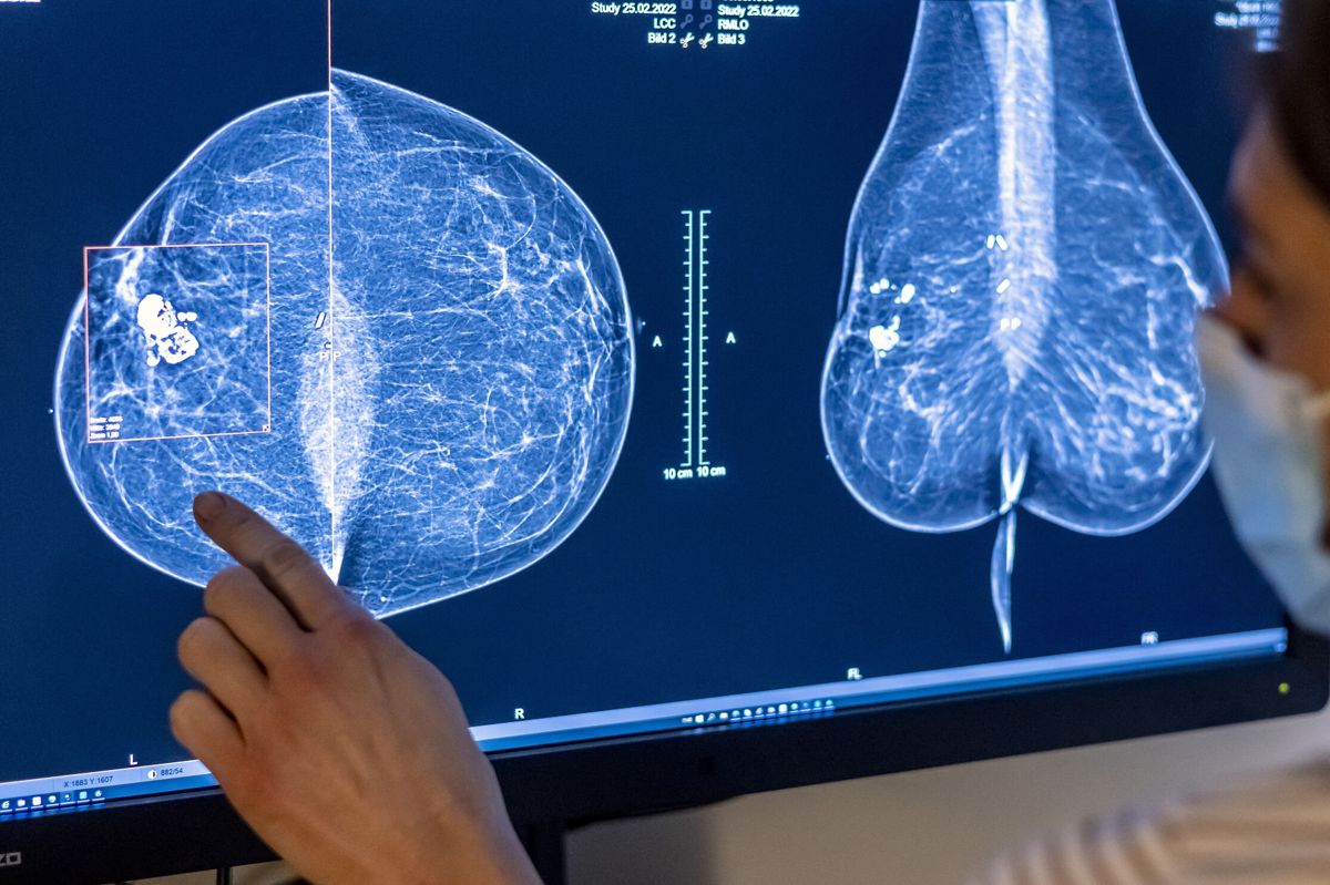 Indtil videre har knap 50 kvinder krævet erstatning, efter at de er blevet indkaldt for sent til screening for brystkræft. (Arkivfoto).