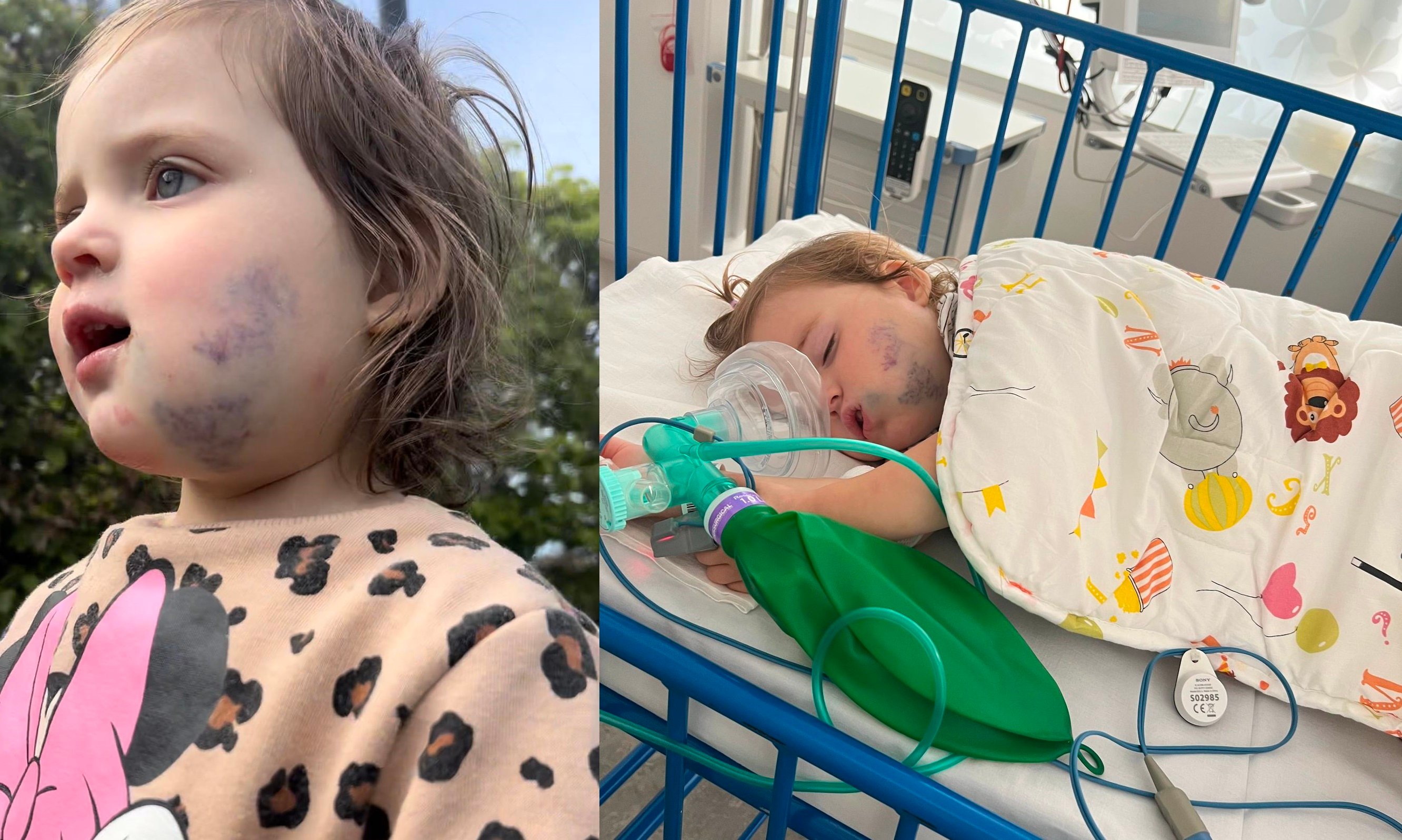 Toårige Hailey er diagnosticeret med den sjældne sygdom venøs malformation, der gør, at hendes kind vokser. Men vokser den for meget, er det ikke længere kun et kosmetisk problem. Så kan det blokere for hendes luftveje. Foto: Privat