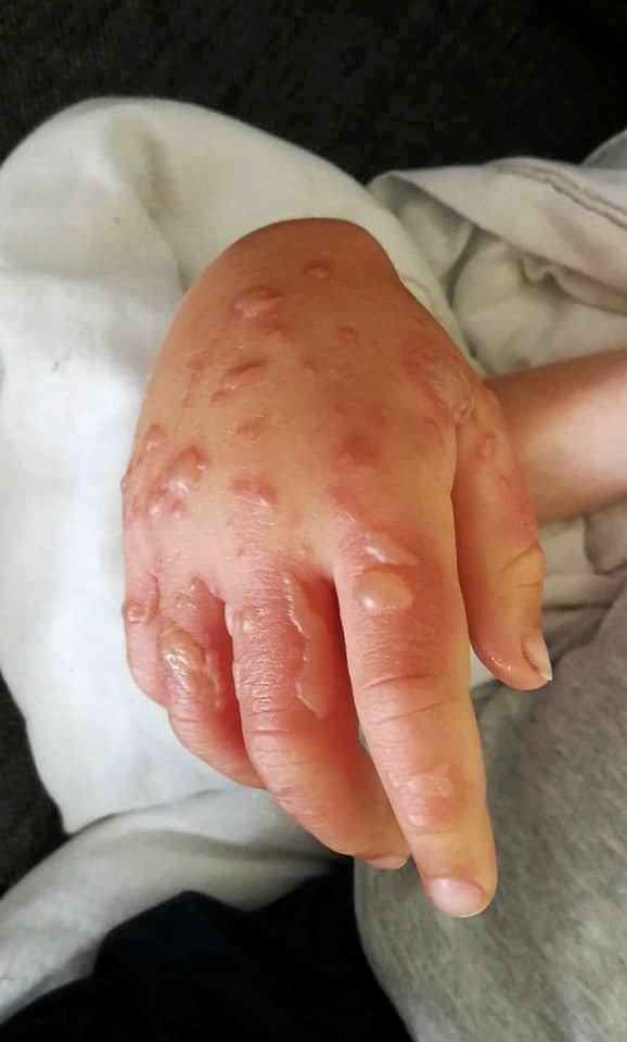 Det kan give slemme vabler at få saften fra gul pastinak på hænderne. Især hvis man bagefter bliver udsat for stærkt sollys.