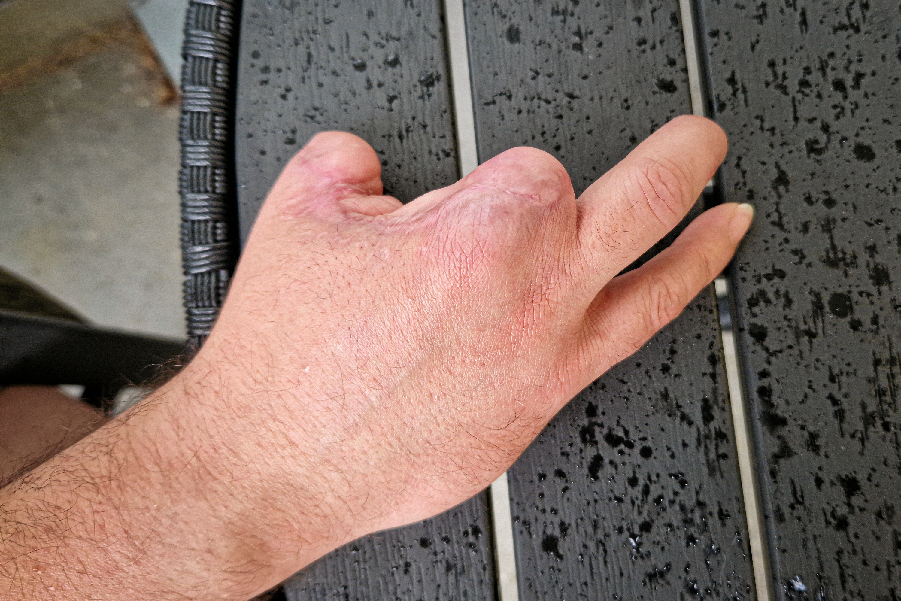 Marius-Adrian Caldaraius højre hånd efter ulykken. Tommelfinger, pegefinger, langfinger og halvdelen af ringfingeren blev mast af i en cellesluse. - Palle Demant Marius-Adrian Caldaraius højre hånd efter ulykken. Tommelfinger, pegefinger, langfinger og halvdelen af ringfingeren blev mast af i en cellesluse.