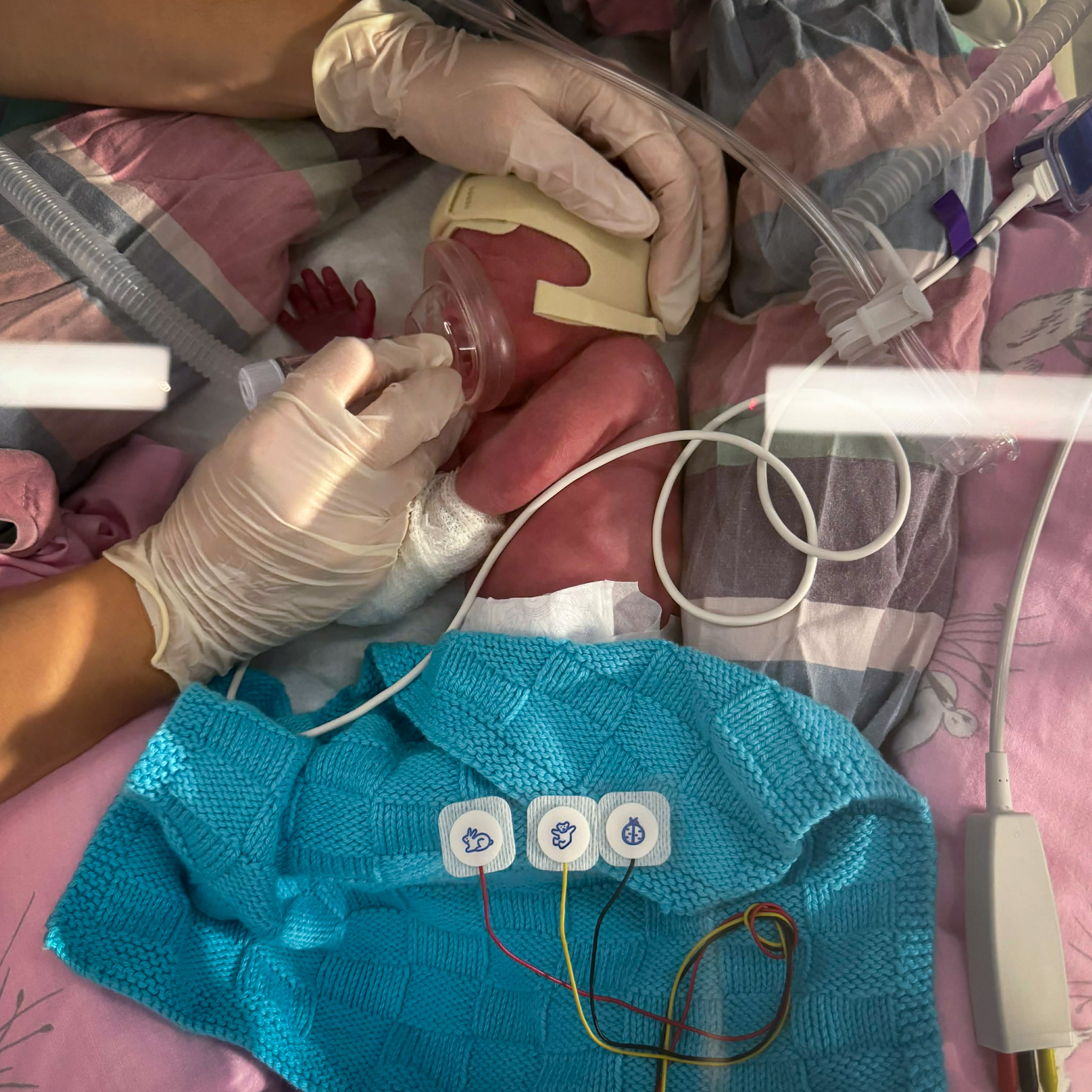 Lille Frode fik en særdeles hård start på livet, og vejede blot 1400 gram da han kom til verden.