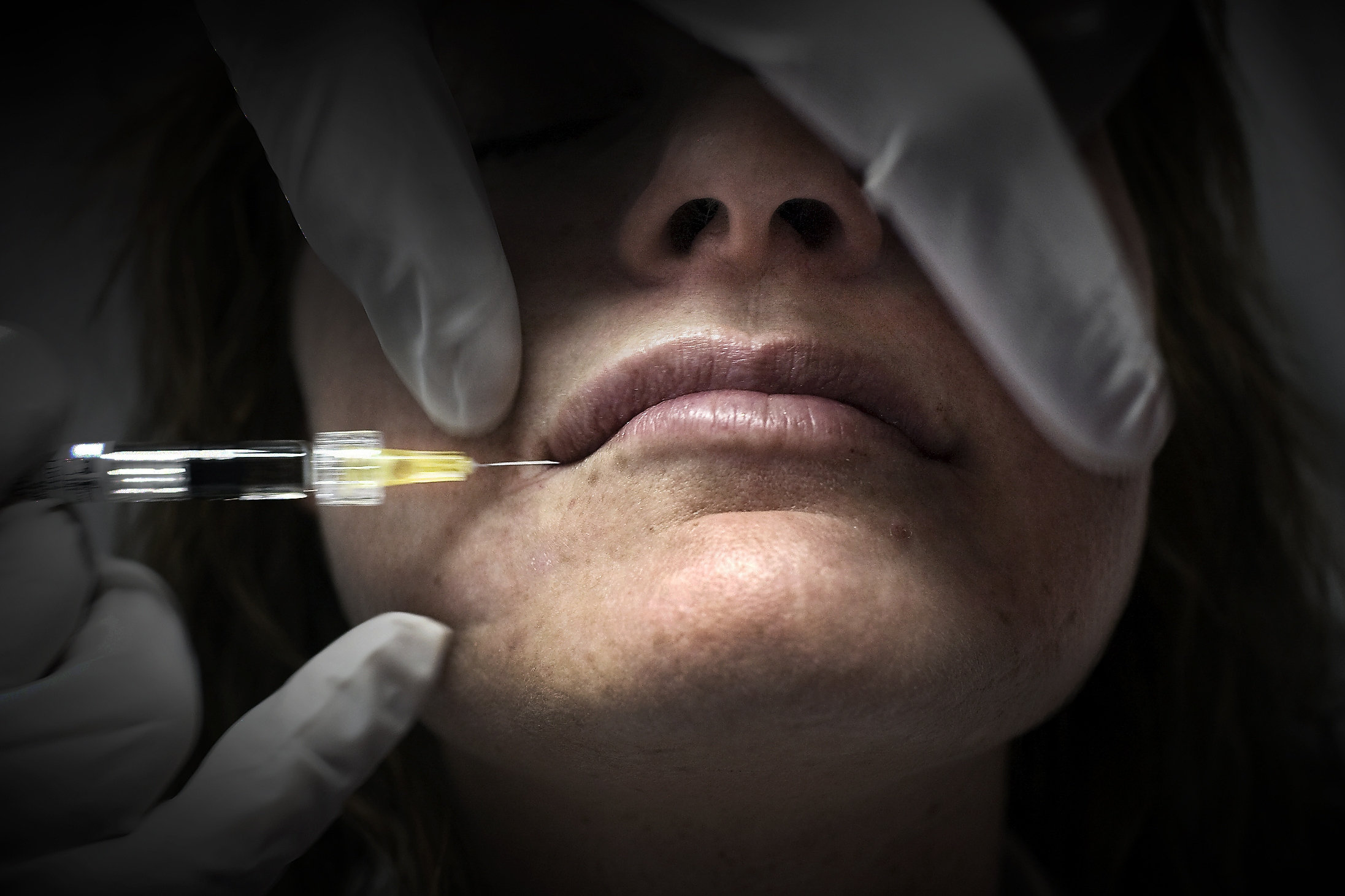 Botox, som fremstilles fra bakterier, bruges ifølge sundhed.dk til at opløse smertefulde krampetilstande hos personer med hjerneskader og lammelser. Men præparatet bruges også af blandt andet skønhedsklinikker. (Arkivfoto).